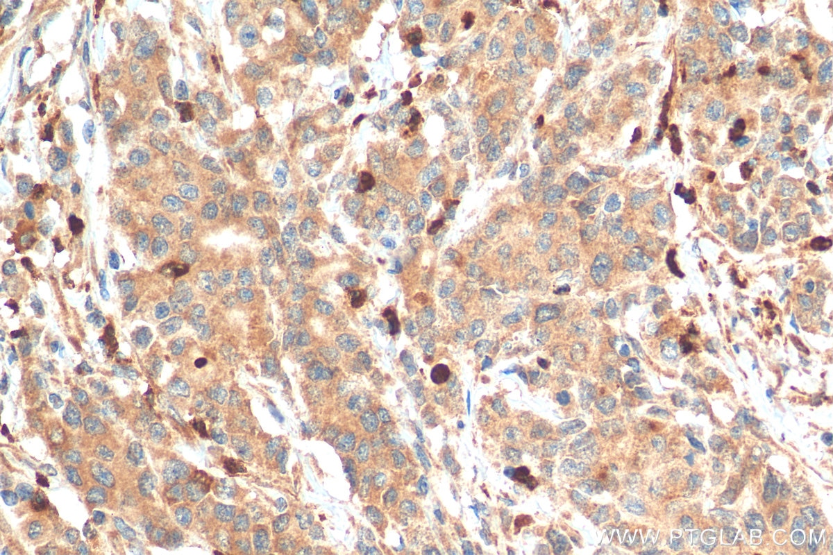 Immunohistochemistry (IHC) staining of human stomach cancer tissue using Lipocalin-2/NGAL Polyclonal antibody (26991-1-AP)