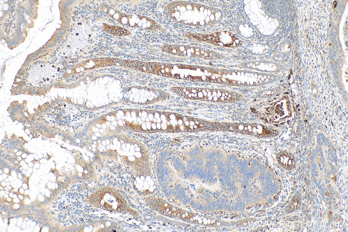 Immunohistochemistry (IHC) staining of human colon cancer tissue using NGAL Polyclonal antibody (30700-1-AP)