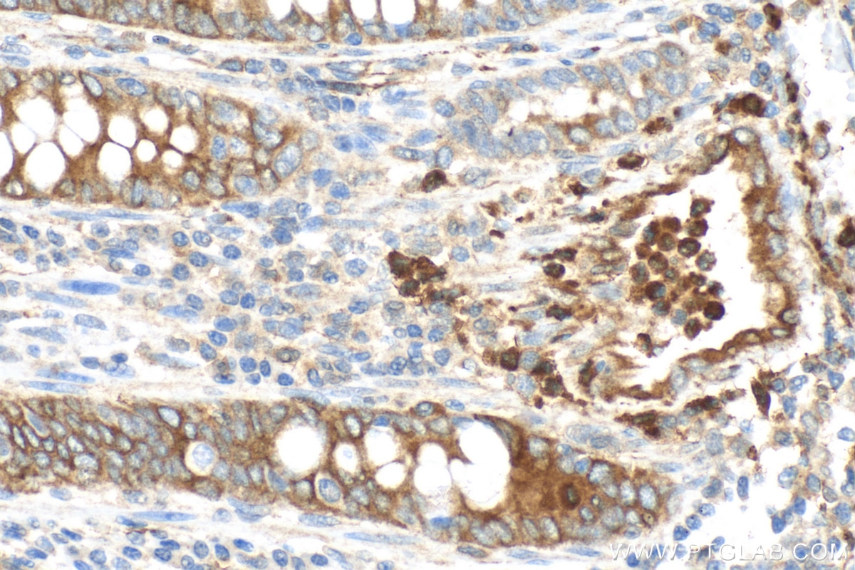 Immunohistochemistry (IHC) staining of human colon cancer tissue using Lipocalin-2/NGAL Polyclonal antibody (30700-1-AP)