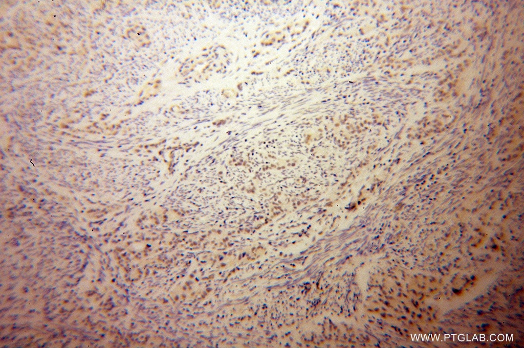 Immunohistochemistry (IHC) staining of human endometrial cancer tissue using LCOR Polyclonal antibody (14476-1-AP)