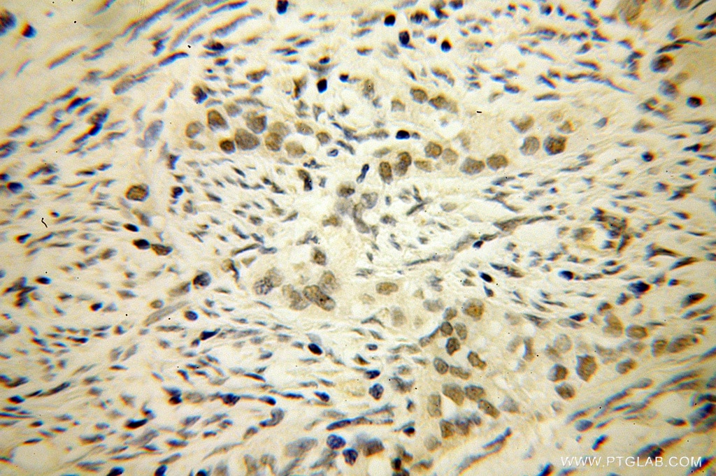 Immunohistochemistry (IHC) staining of human endometrial cancer tissue using LCOR Polyclonal antibody (14476-1-AP)