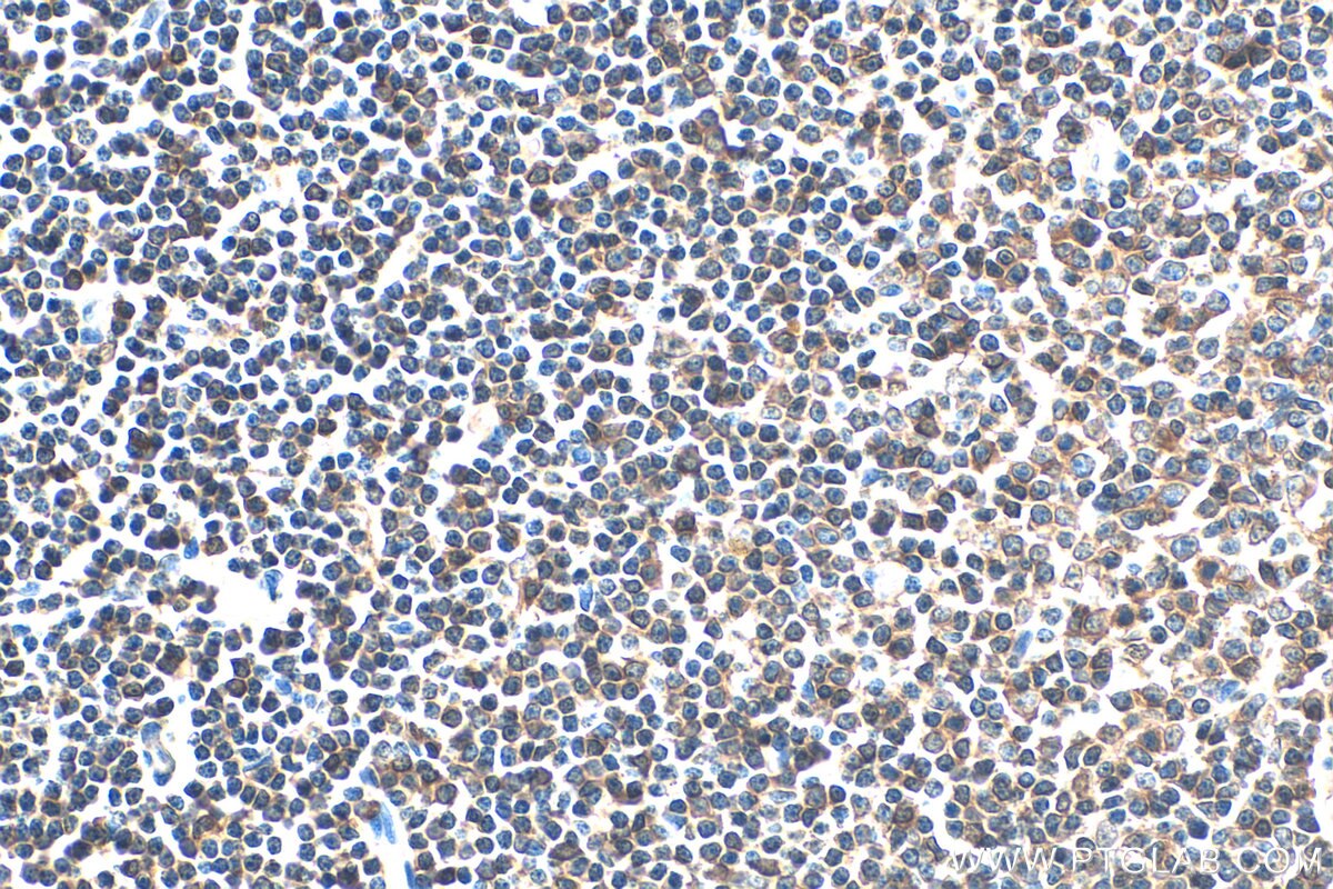 Immunohistochemistry (IHC) staining of human lymphoma tissue using L-Plastin Polyclonal antibody (13025-1-AP)