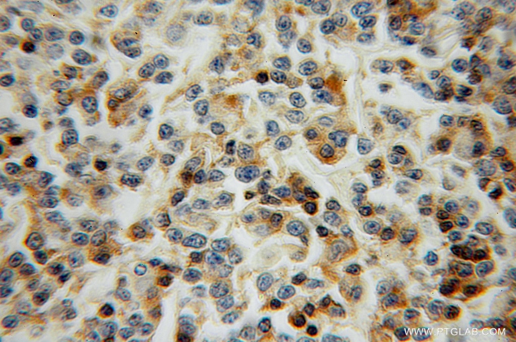 Immunohistochemistry (IHC) staining of human lymphoma tissue using L-Plastin Polyclonal antibody (13025-1-AP)
