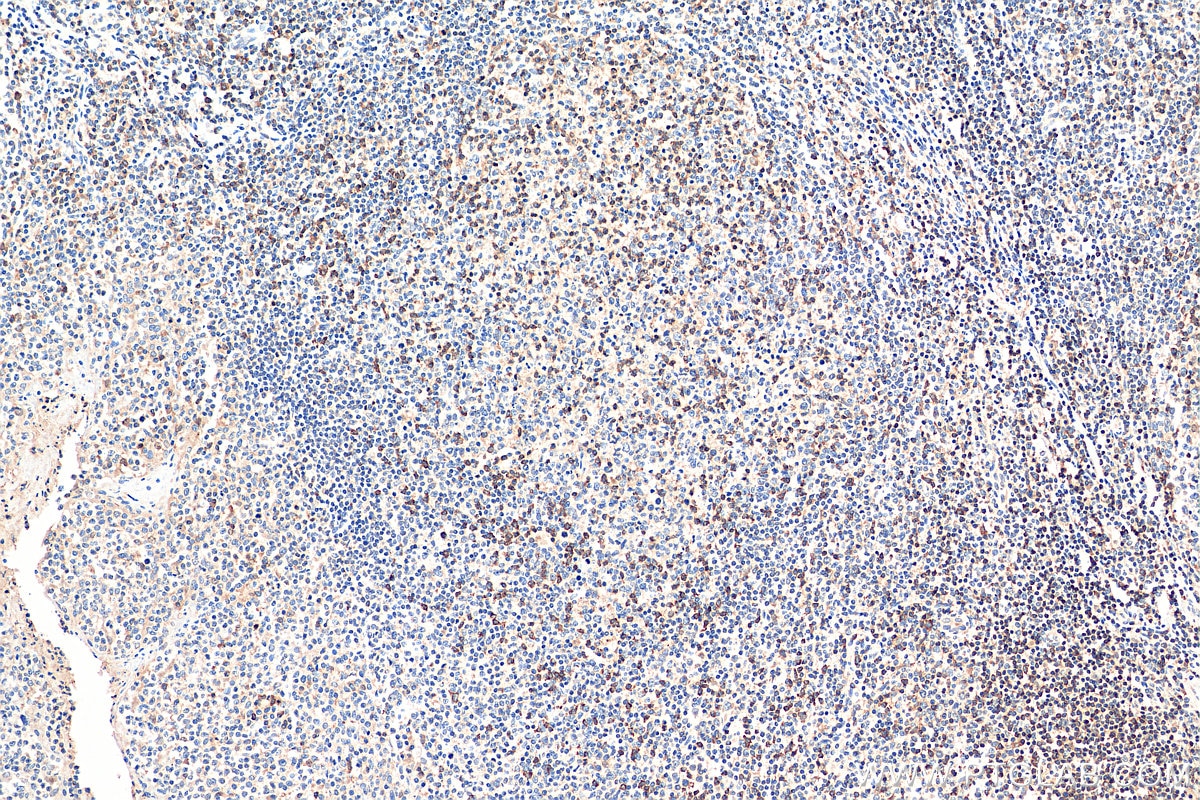 Immunohistochemistry (IHC) staining of human tonsillitis tissue using SLP76 Polyclonal antibody (12728-1-AP)