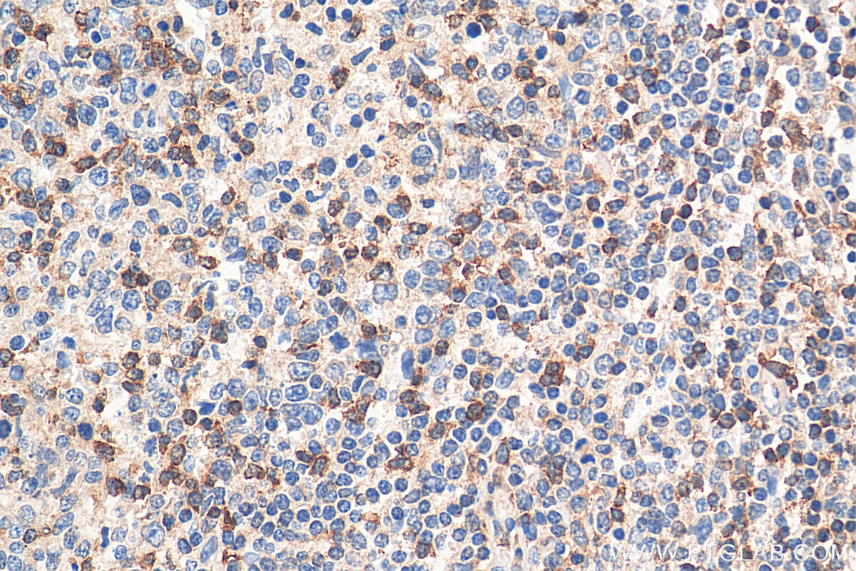 Immunohistochemistry (IHC) staining of human tonsillitis tissue using SLP76 Polyclonal antibody (12728-1-AP)