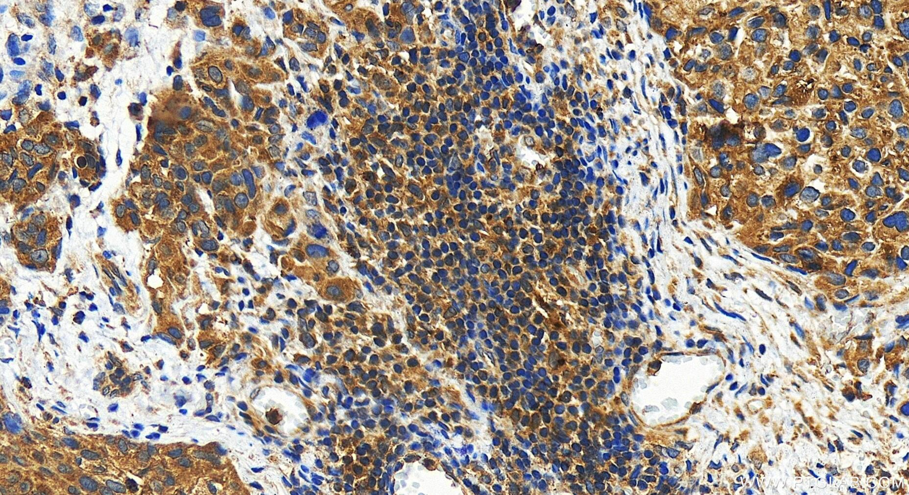 Immunohistochemistry (IHC) staining of human ovary cancer tissue using LDAH Polyclonal antibody (31714-1-AP)