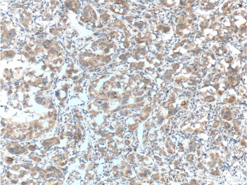 Immunohistochemistry (IHC) staining of human liver cancer tissue using LDHA Monoclonal antibody (66287-1-Ig)