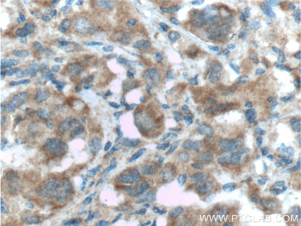 Immunohistochemistry (IHC) staining of human liver cancer tissue using LDHA Monoclonal antibody (66287-1-Ig)