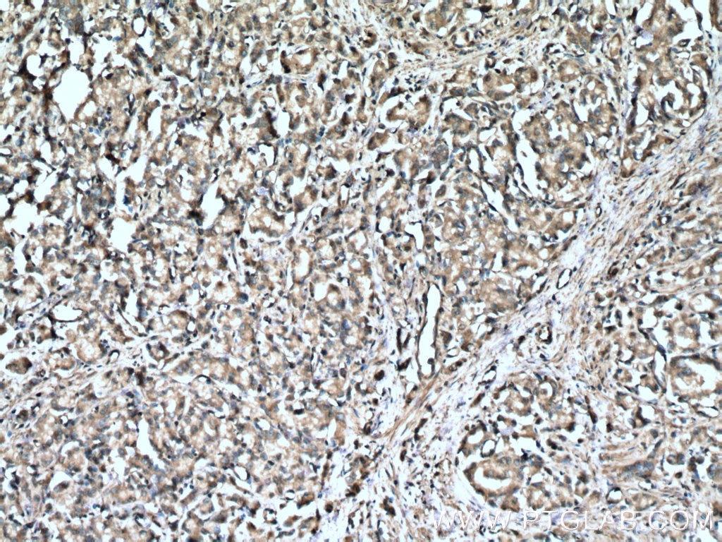 IHC staining of human prostate cancer using 14824-1-AP