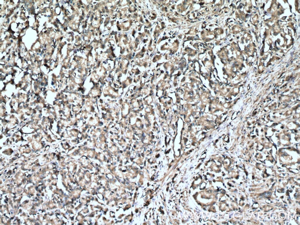 Immunohistochemistry (IHC) staining of human prostate cancer tissue using LDHB Polyclonal antibody (14824-1-AP)