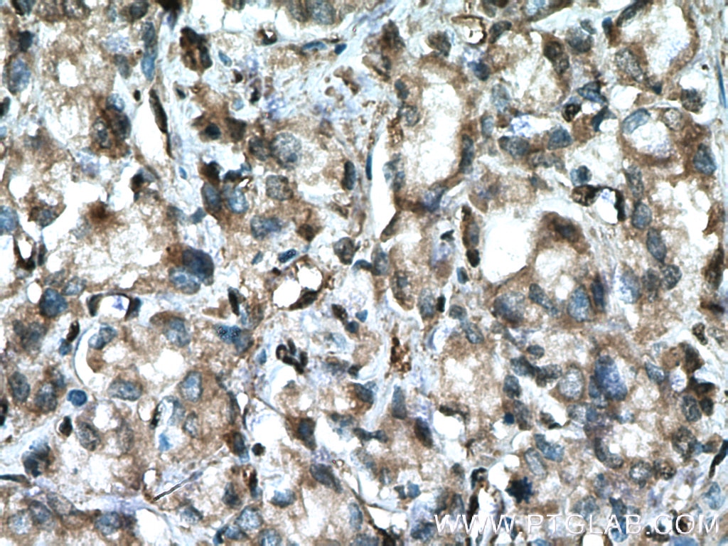 Immunohistochemistry (IHC) staining of human prostate cancer tissue using LDHB Polyclonal antibody (14824-1-AP)