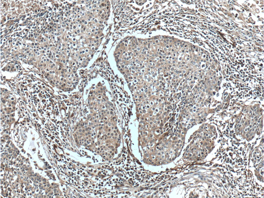IHC staining of human lung cancer using 19988-1-AP