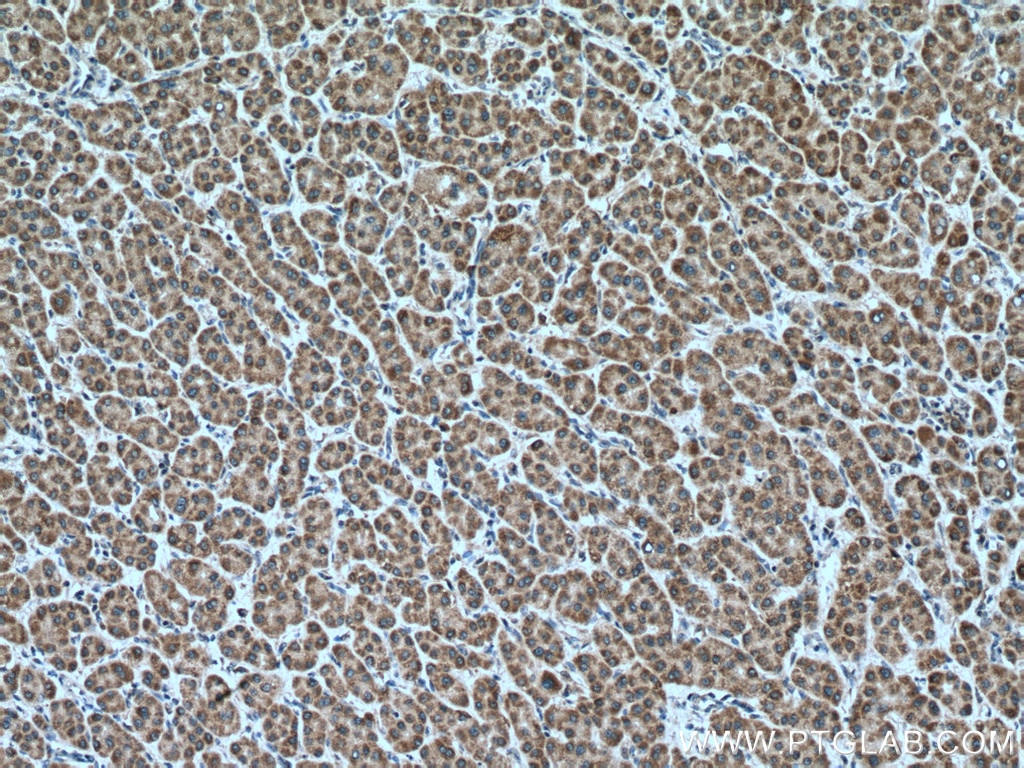 Immunohistochemistry (IHC) staining of human liver cancer tissue using LDHD Polyclonal antibody (14398-1-AP)