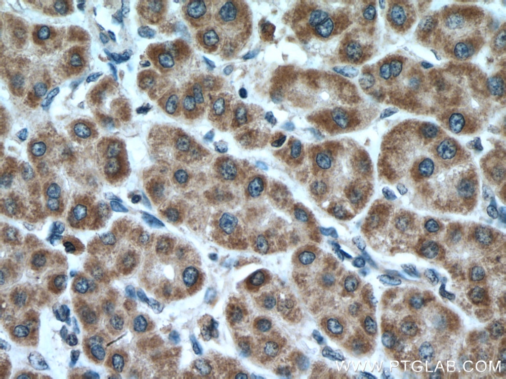 Immunohistochemistry (IHC) staining of human liver cancer tissue using LDHD Polyclonal antibody (14398-1-AP)