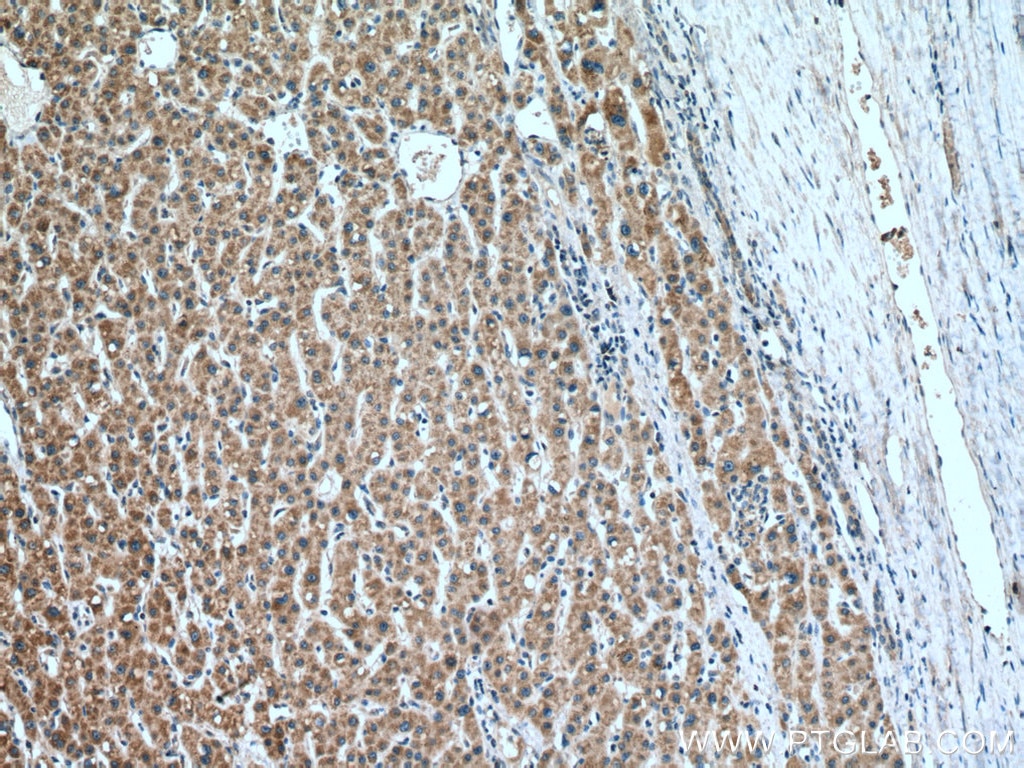 Immunohistochemistry (IHC) staining of human liver cancer tissue using LDHD Polyclonal antibody (14398-1-AP)