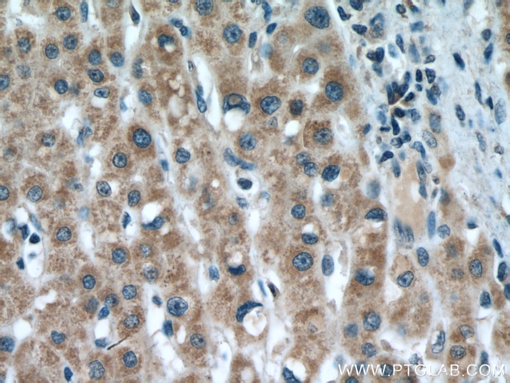 Immunohistochemistry (IHC) staining of human liver cancer tissue using LDHD Polyclonal antibody (14398-1-AP)