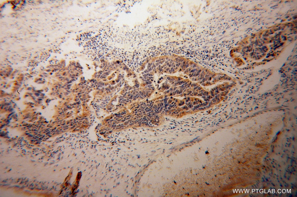 Immunohistochemistry (IHC) staining of human osteosarcoma tissue using LDHD Polyclonal antibody (14398-1-AP)