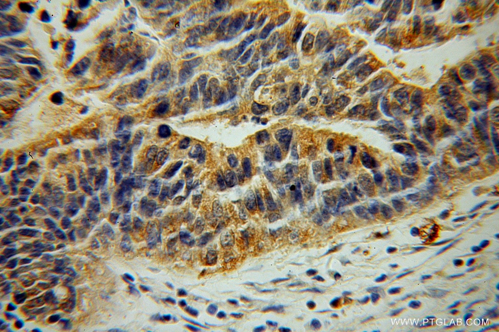 Immunohistochemistry (IHC) staining of human osteosarcoma tissue using LDHD Polyclonal antibody (14398-1-AP)