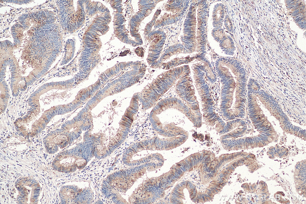 Immunohistochemistry (IHC) staining of human colon cancer tissue using LDLR Polyclonal antibody (10785-1-AP)