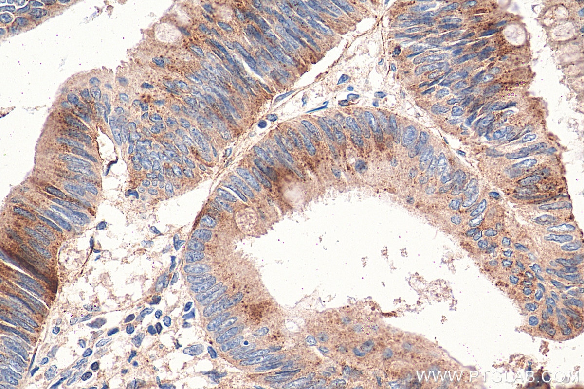 Immunohistochemistry (IHC) staining of human colon cancer tissue using LDLR Polyclonal antibody (10785-1-AP)