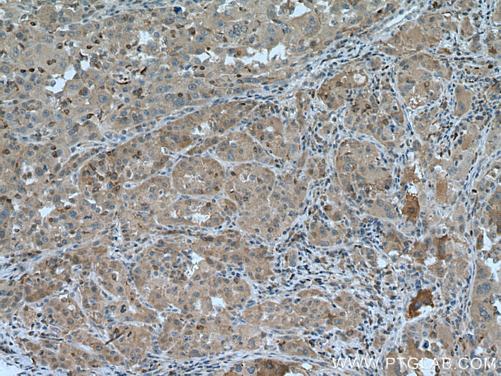 Immunohistochemistry (IHC) staining of human liver cancer tissue using ARH Polyclonal antibody (13213-1-AP)