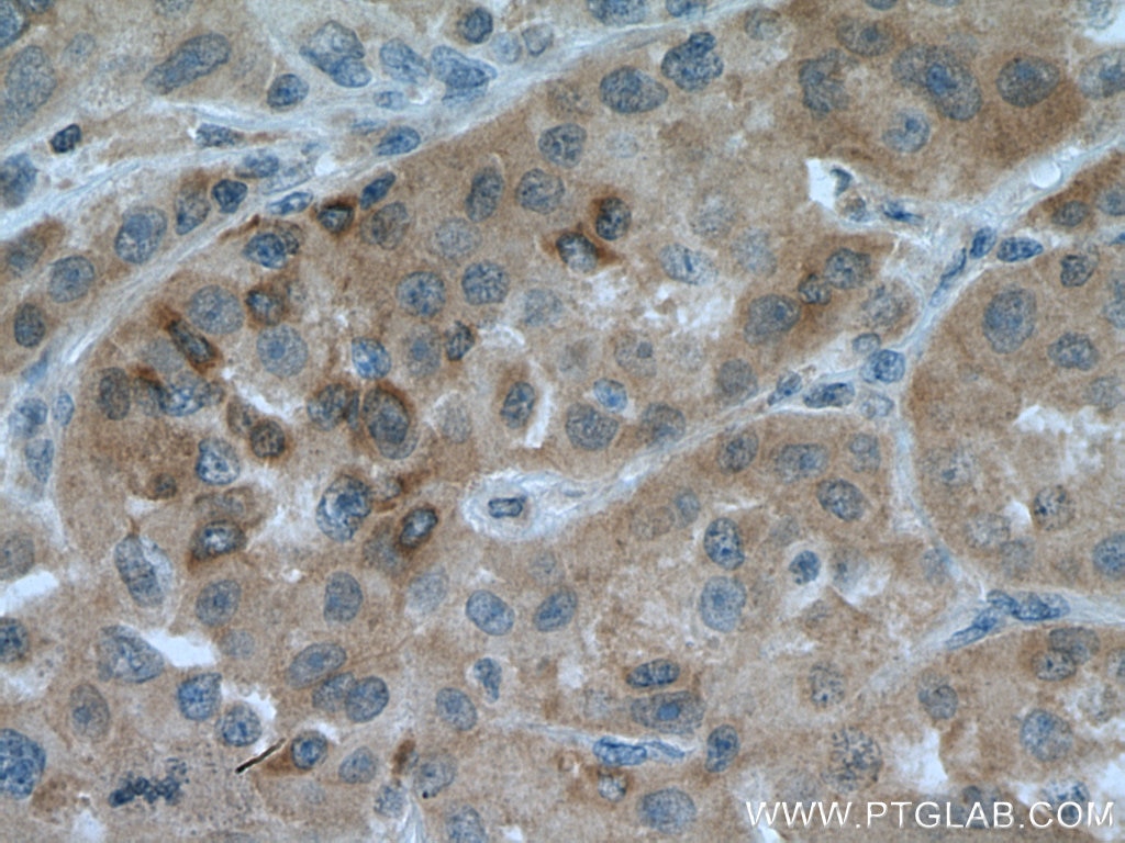Immunohistochemistry (IHC) staining of human liver cancer tissue using ARH Polyclonal antibody (13213-1-AP)