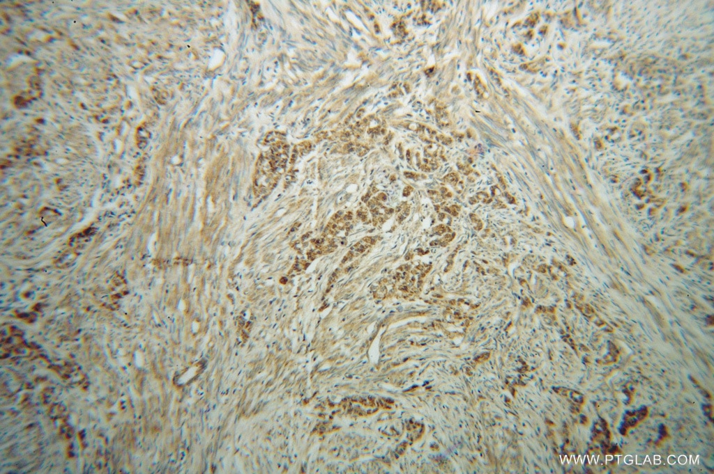 Immunohistochemistry (IHC) staining of human endometrial cancer tissue using LEFTY2 Polyclonal antibody (13991-1-AP)