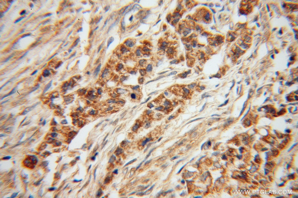 Immunohistochemistry (IHC) staining of human endometrial cancer tissue using LEFTY2 Polyclonal antibody (13991-1-AP)