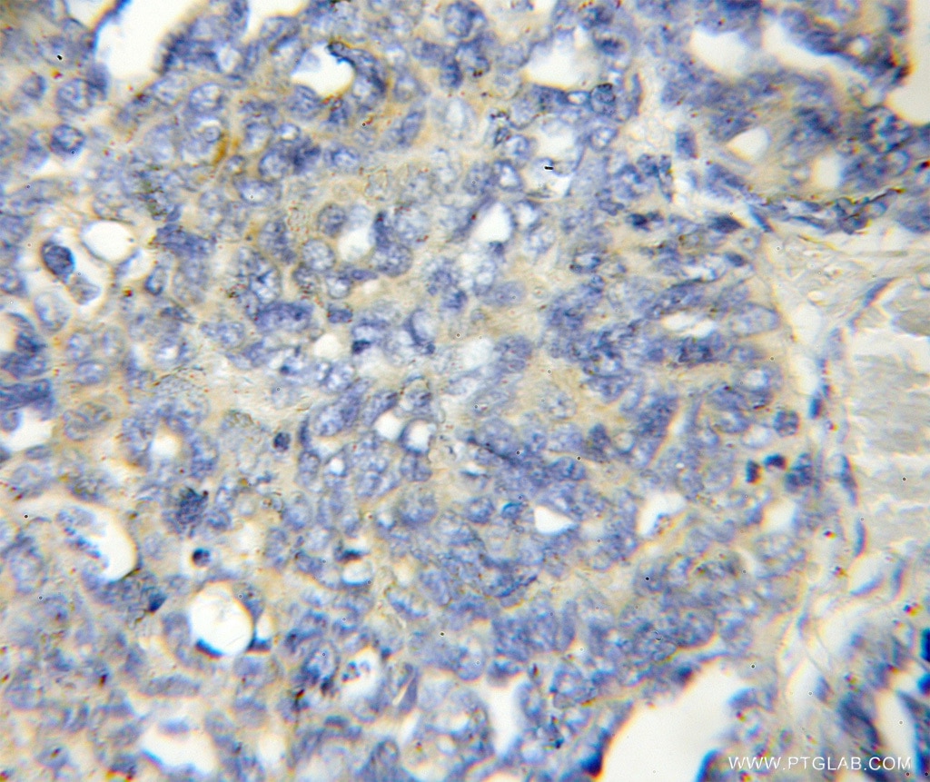 Immunohistochemistry (IHC) staining of human ovary tumor tissue using LENG1 Polyclonal antibody (11406-1-AP)