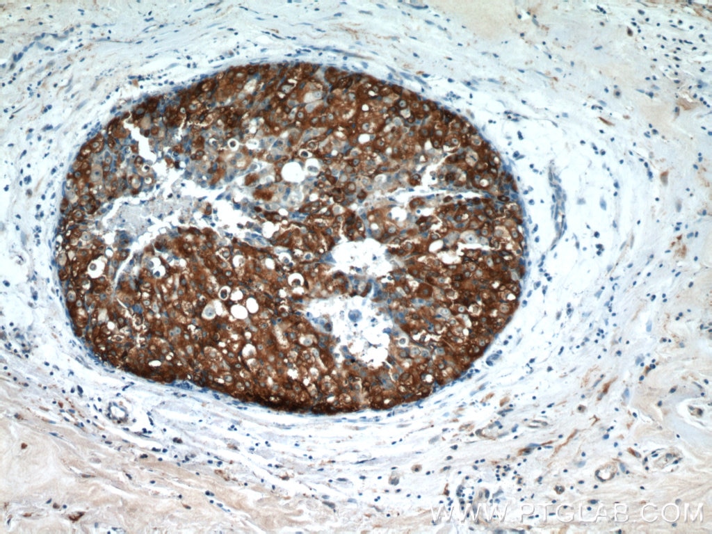 Immunohistochemistry (IHC) staining of human breast cancer tissue using Leptin Polyclonal antibody (17436-1-AP)