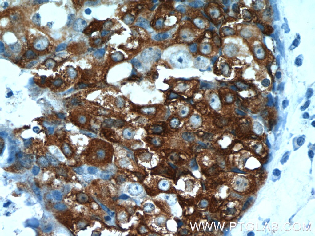 Immunohistochemistry (IHC) staining of human breast cancer tissue using Leptin Polyclonal antibody (17436-1-AP)