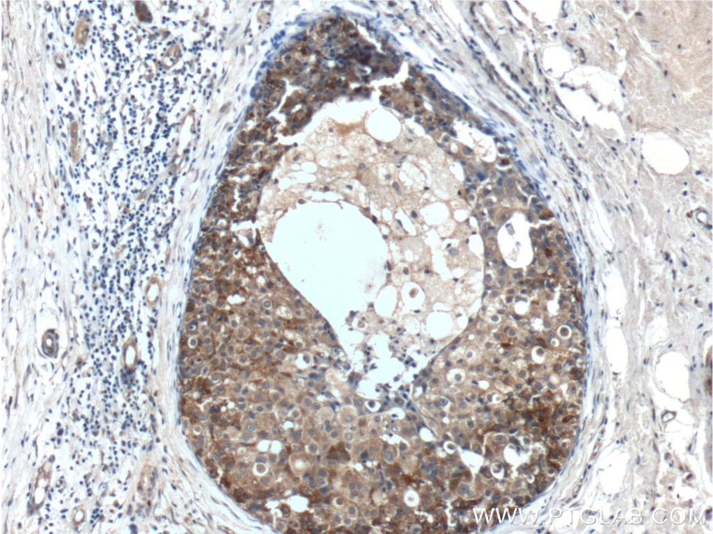 IHC staining of human breast cancer using 17436-1-AP