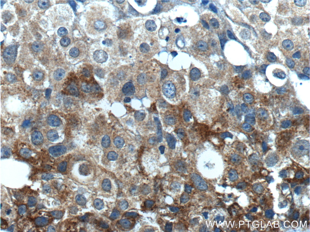 Immunohistochemistry (IHC) staining of human breast cancer tissue using Leptin Polyclonal antibody (17436-1-AP)