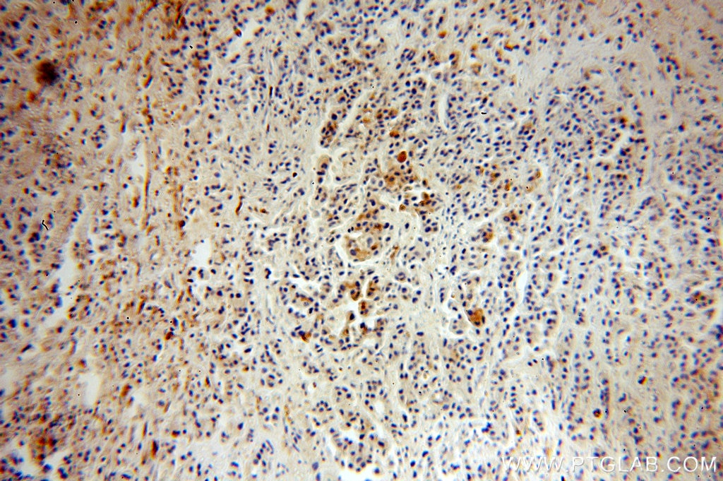 Immunohistochemistry (IHC) staining of human breast cancer tissue using Leptin Polyclonal antibody (17436-1-AP)