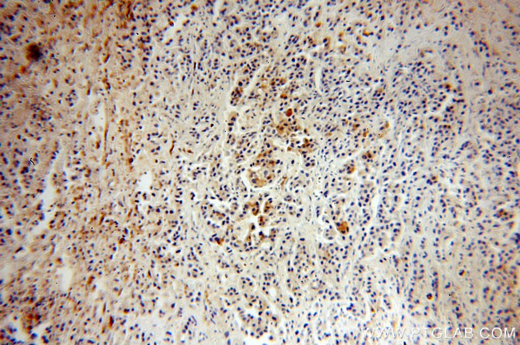 IHC staining of human breast cancer using 17436-1-AP