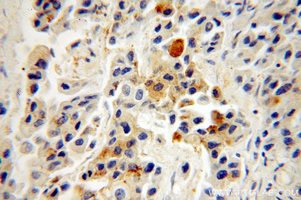 Immunohistochemistry (IHC) staining of human breast cancer tissue using Leptin Polyclonal antibody (17436-1-AP)