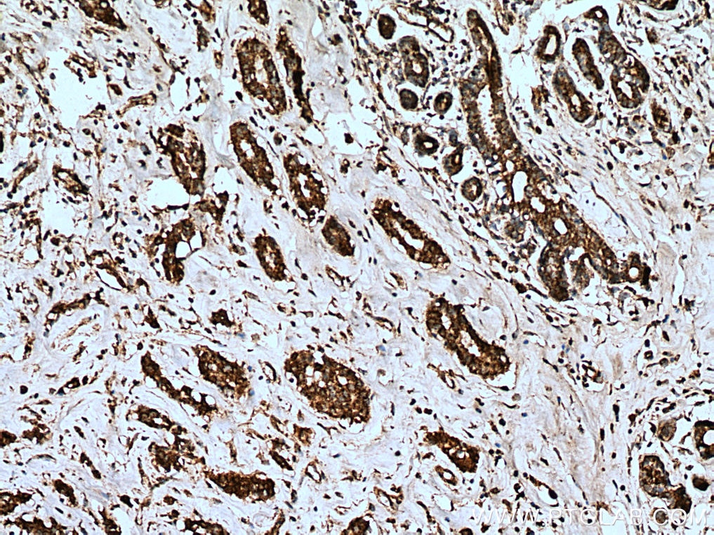 IHC staining of human breast cancer using 16024-1-AP