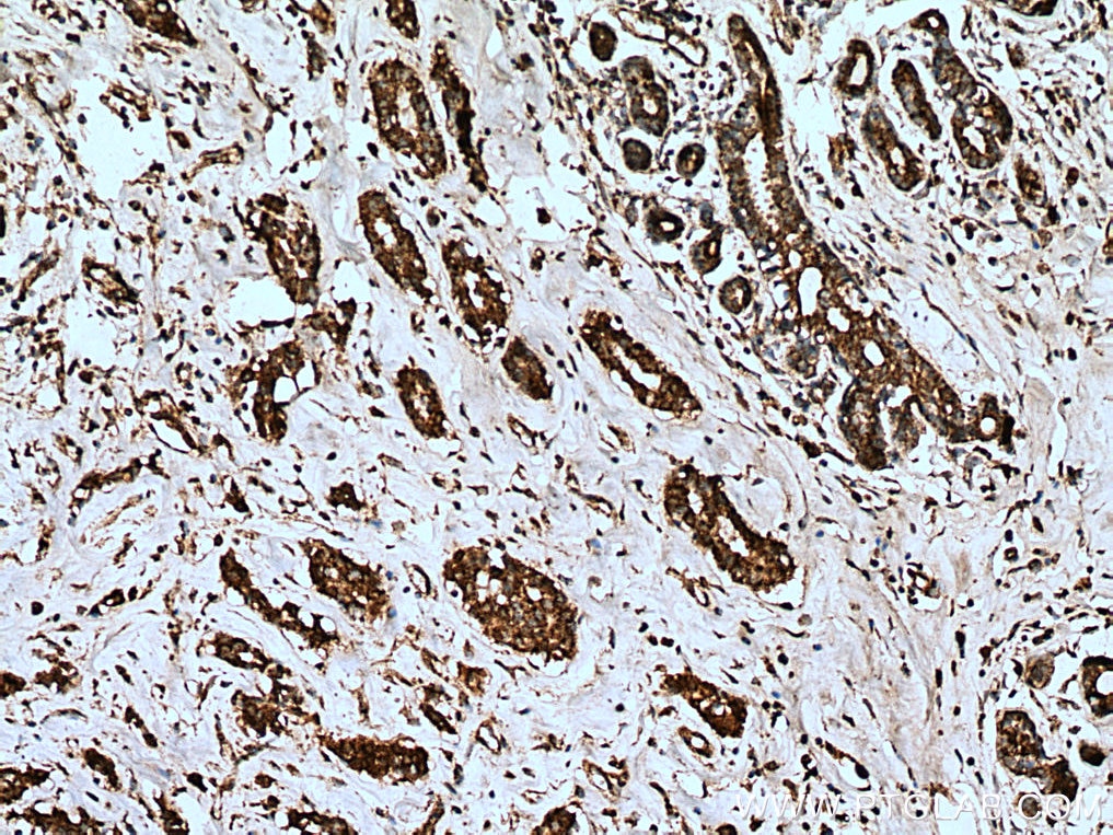 Immunohistochemistry (IHC) staining of human breast cancer tissue using LETM1 Polyclonal antibody (16024-1-AP)