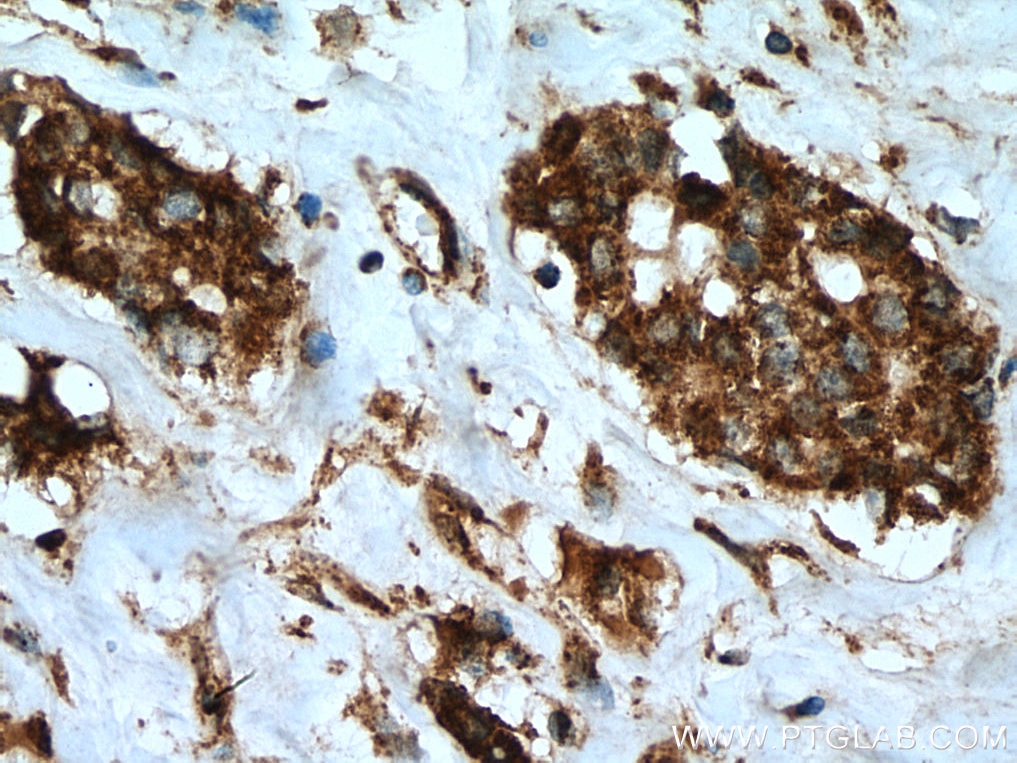Immunohistochemistry (IHC) staining of human breast cancer tissue using LETM1 Polyclonal antibody (16024-1-AP)