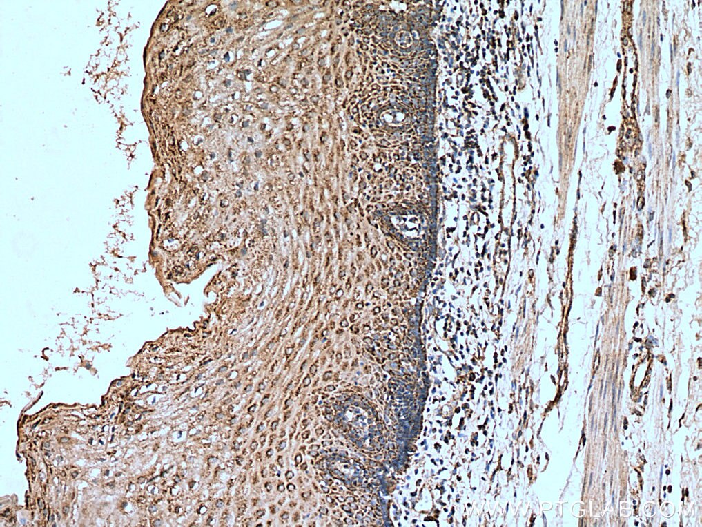Immunohistochemistry (IHC) staining of human oesophagus cancer tissue using LETM1 Polyclonal antibody (16024-1-AP)