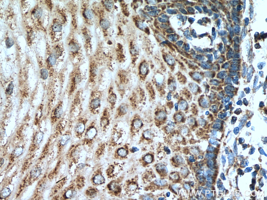 Immunohistochemistry (IHC) staining of human oesophagus cancer tissue using LETM1 Polyclonal antibody (16024-1-AP)