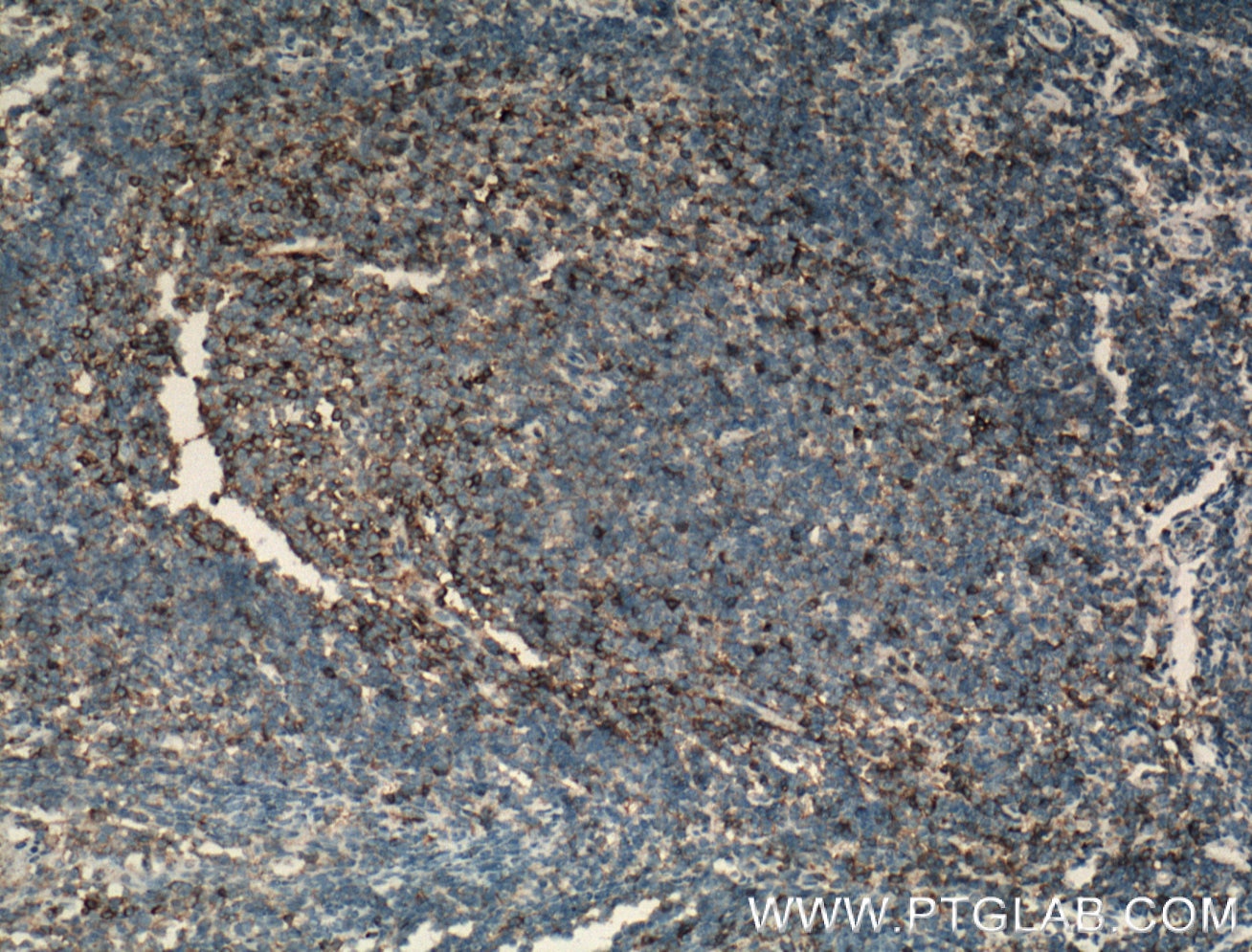 Immunohistochemistry (IHC) staining of human tonsillitis tissue using CD11a/Integrin Alpha L Polyclonal antibody (15574-1-AP)