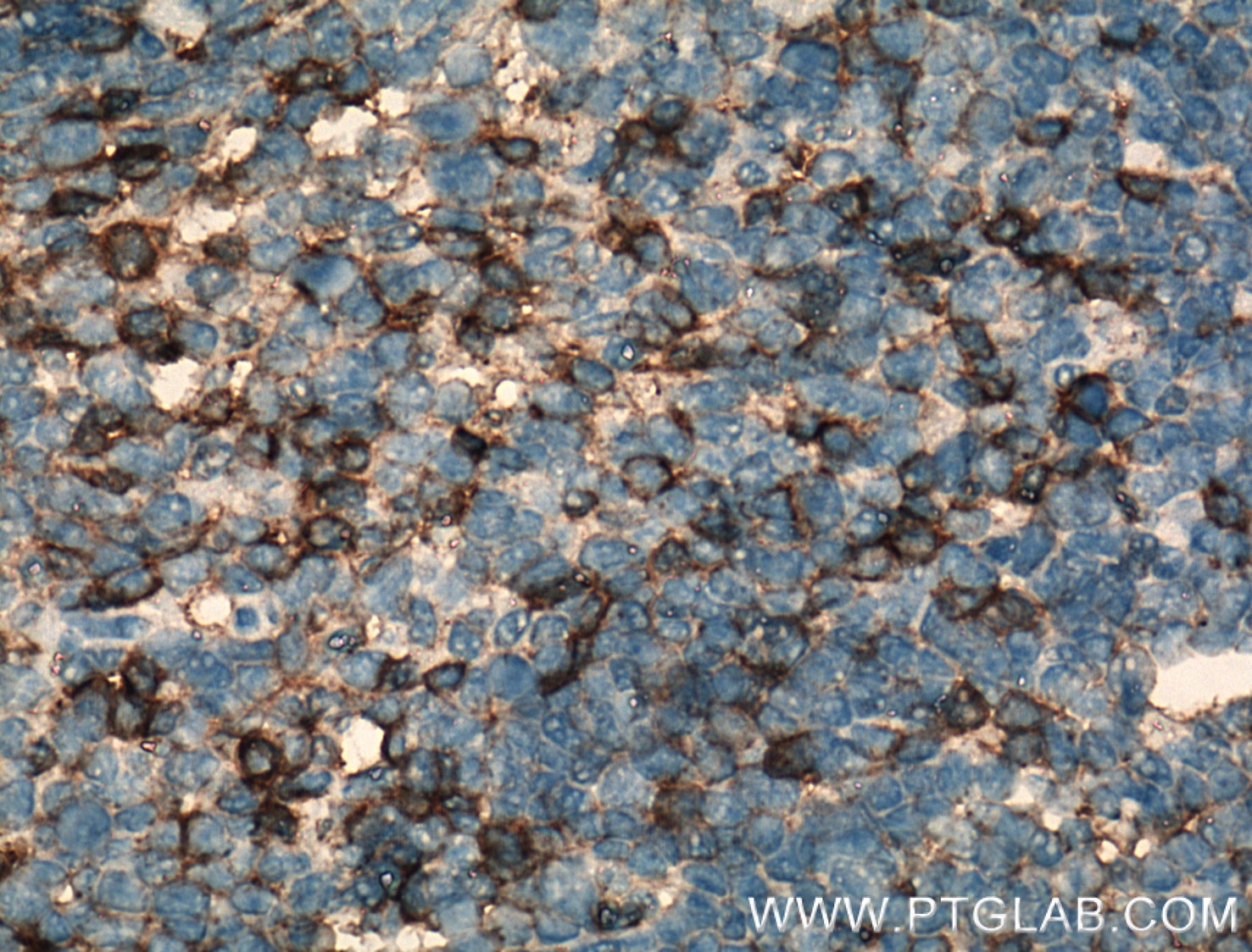 Immunohistochemistry (IHC) staining of human tonsillitis tissue using CD11a/Integrin Alpha L Polyclonal antibody (15574-1-AP)