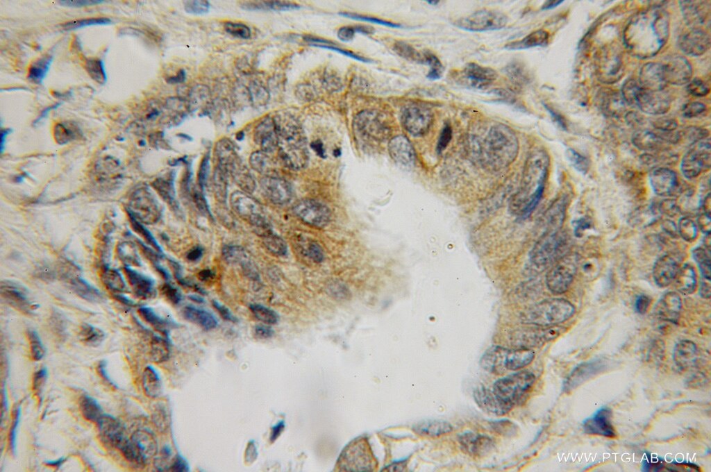 Immunohistochemistry (IHC) staining of human colon cancer tissue using Galectin 2 Polyclonal antibody (12849-2-AP)