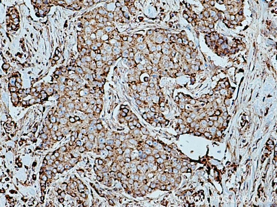 IHC staining of human breast cancer using 10281-1-AP