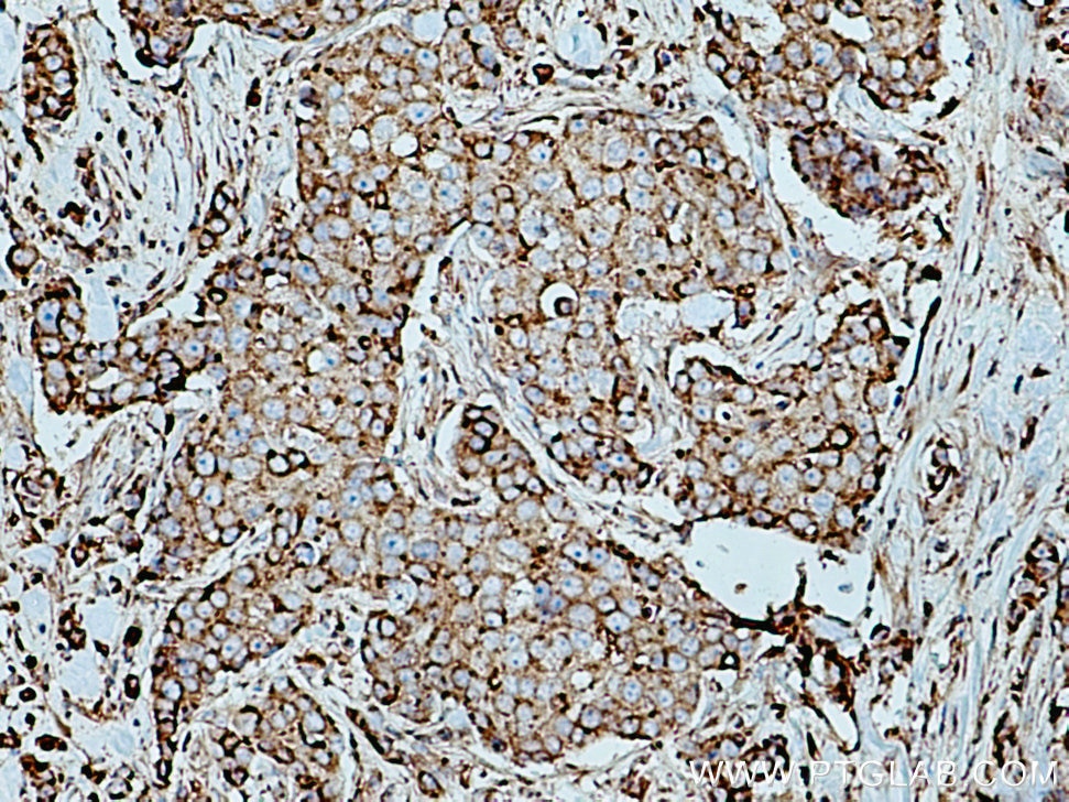 Immunohistochemistry (IHC) staining of human breast cancer tissue using LGALS3BP Polyclonal antibody (10281-1-AP)