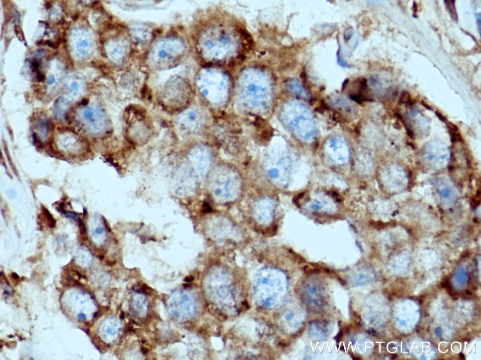 Immunohistochemistry (IHC) staining of human breast cancer tissue using LGALS3BP Polyclonal antibody (10281-1-AP)