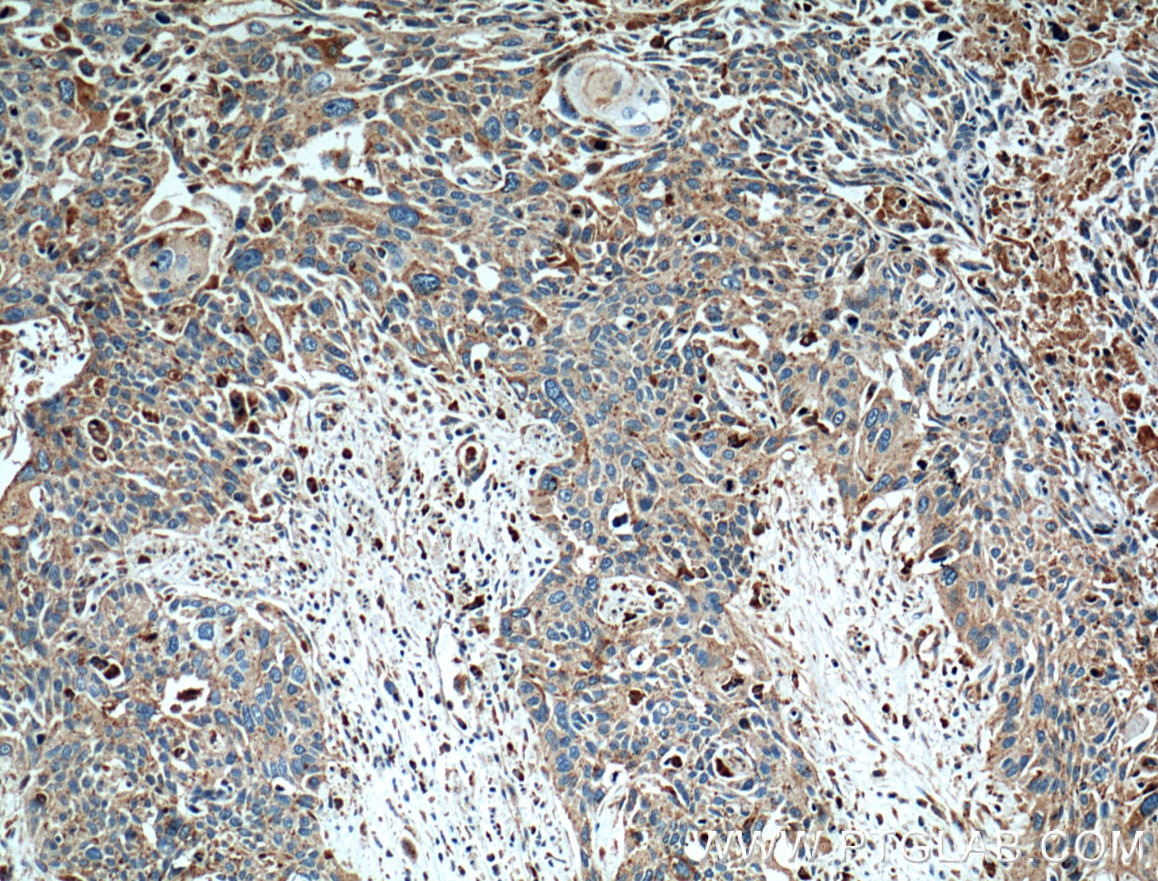 IHC staining of human oesophagus cancer using 10281-1-AP