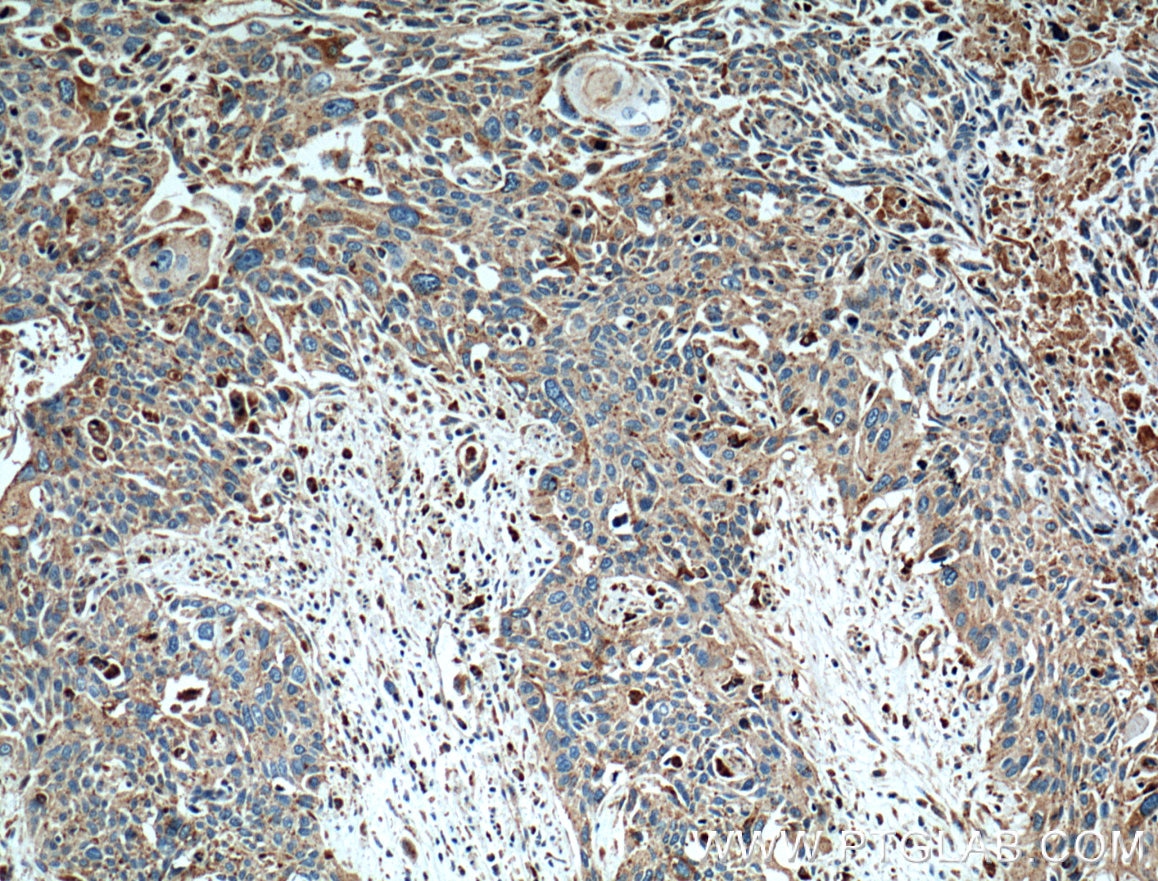 Immunohistochemistry (IHC) staining of human oesophagus cancer tissue using LGALS3BP Polyclonal antibody (10281-1-AP)