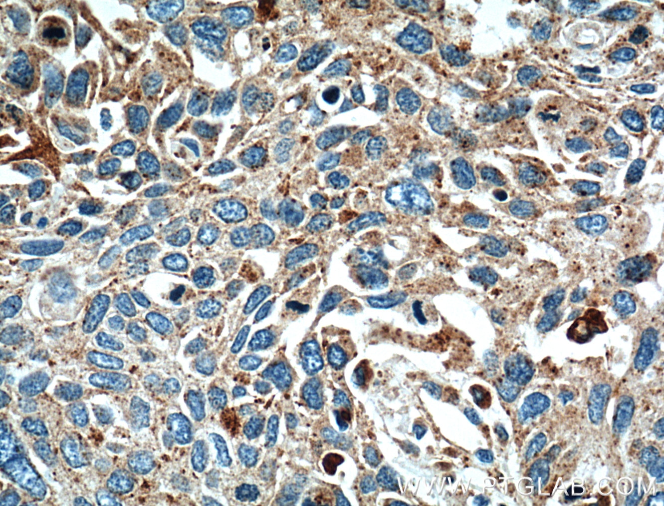 Immunohistochemistry (IHC) staining of human oesophagus cancer tissue using LGALS3BP Polyclonal antibody (10281-1-AP)